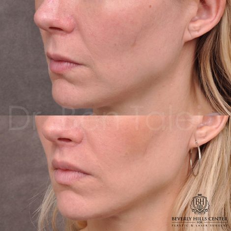 Modified Upper lip lift - Left side