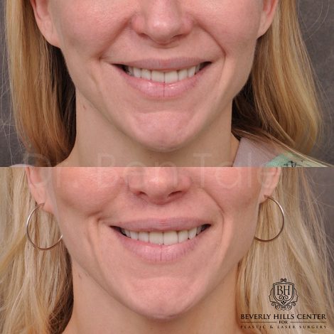 Modified Upper lip lift - Front