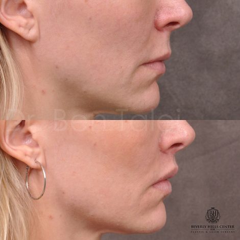Modified Upper lip lift - Right side