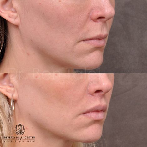 Modified Upper lip lift - Right side