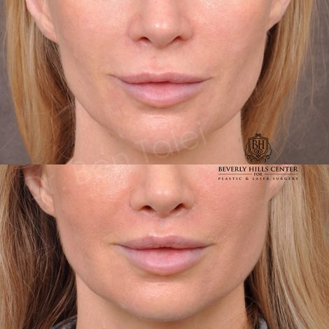 Modified Upper lip lift - Front