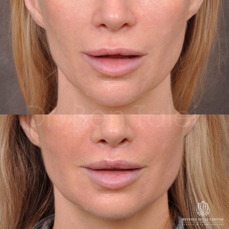 Modified Upper lip lift - Front
