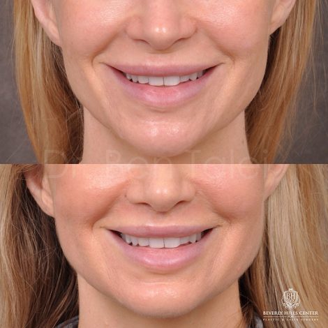 Modified Upper lip lift - Front