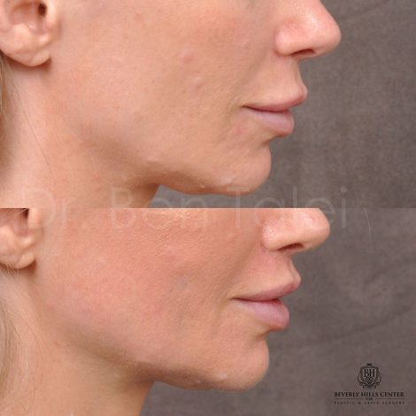 Modified Upper lip lift - Right side