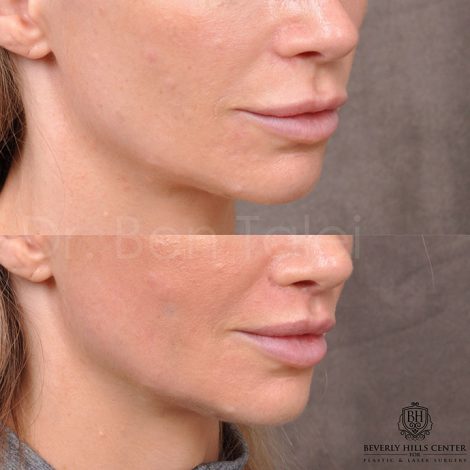 Modified Upper lip lift - Right side