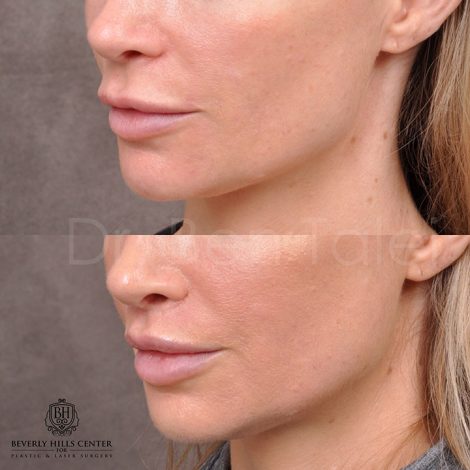 Modified Upper lip lift - Left side