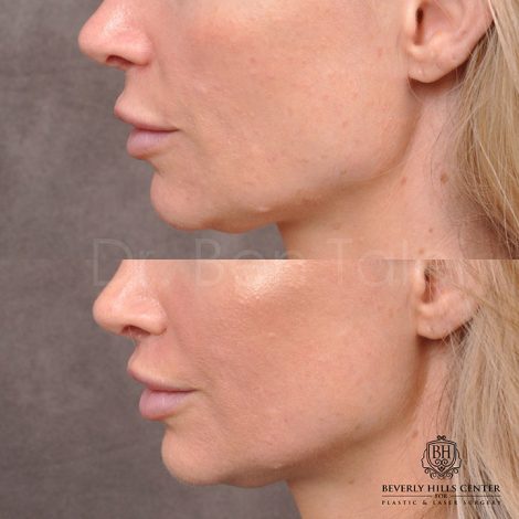 Modified Upper lip lift - Left side