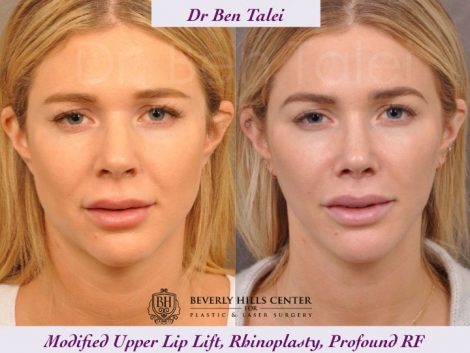Rhinoplasty, Modified Upper Lip Lift, Profound RF - Front