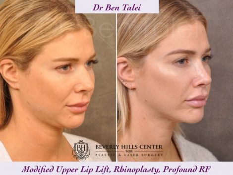Rhinoplasty, Modified Upper Lip Lift, Profound RF - Right Side