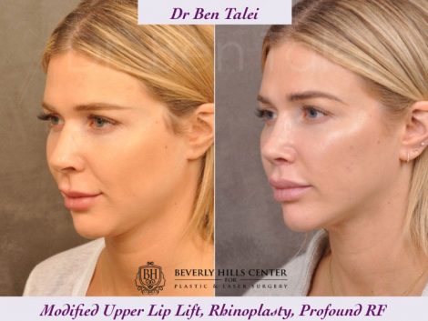 Rhinoplasty, Modified Upper Lip Lift, Profound RF - Left Side