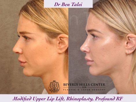 Rhinoplasty, Modified Upper Lip Lift, Profound RF - Left Side