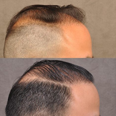 Dr. Ben Talei himself at the 8 months post-op mark.