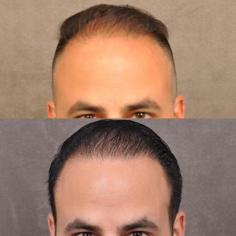 Dr. Ben Talei himself at the 8 months post-op mark.