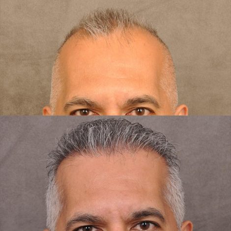 Beverly Hills Center Male Patient Before and After FUE hair transplant and Platelet Rich Plasma