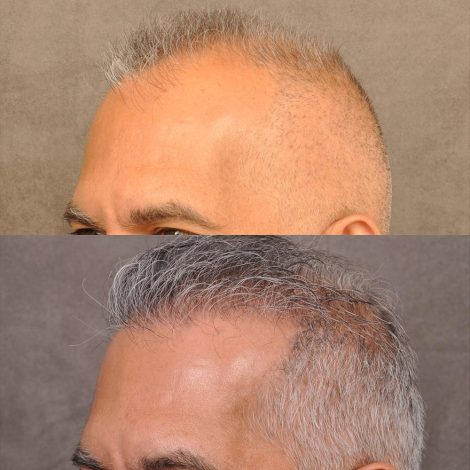 Beverly Hills Center Male Patient Before and After FUE hair transplant and Platelet Rich Plasma