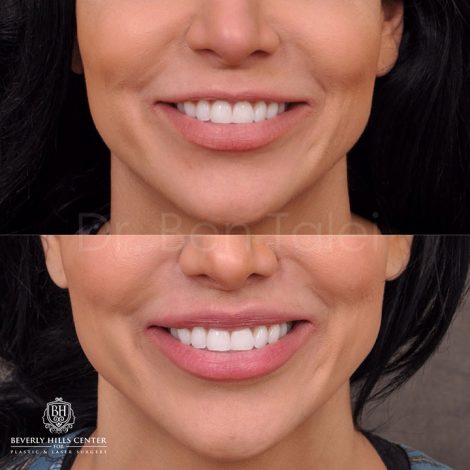 Modified Upper Lip Lift - Front