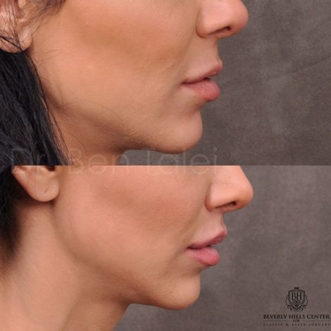 Modified Upper Lip Lift - Right Side