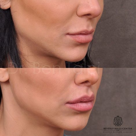 Modified Upper Lip Lift - Right Side