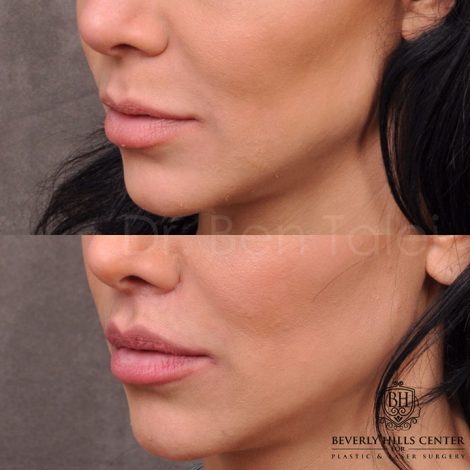 Modified Upper Lip Lift - Left Side