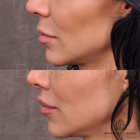 Modified Upper Lip Lift - Left Side