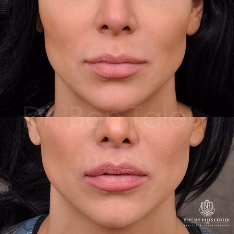 Modified Upper Lip Lift - Front