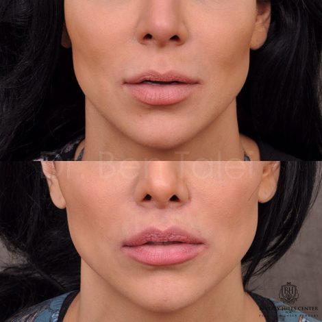 Modified Upper Lip Lift - Front