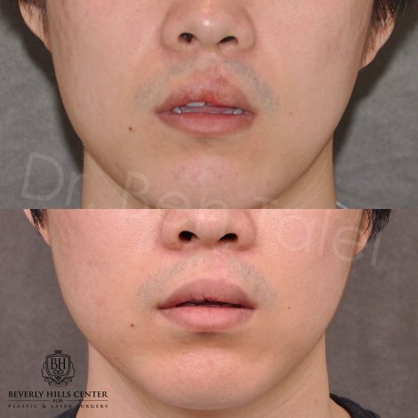 Beverly Hills Center Young Asian Male Patient Before and After Cleft Lip Scar Revision