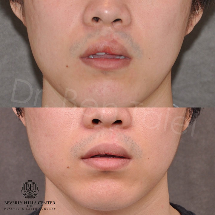 Scars On Lips Treatment