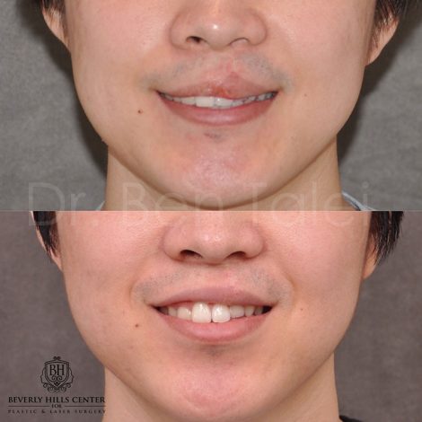 Beverly Hills Center Young Asian Male Patient Before and After Cleft Lip Scar Revision