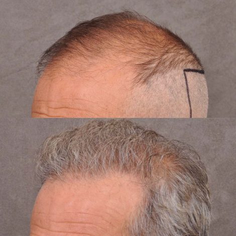 Beverly Hills Center Male Patient Before and After FUE hair transplant and Platelet Rich Plasma