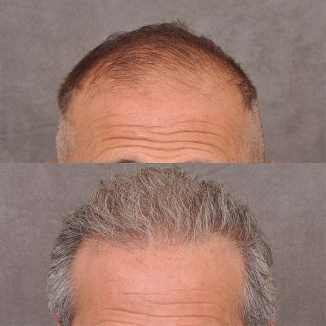 Beverly Hills Center Male Patient Before and After FUE hair transplant and Platelet Rich Plasma