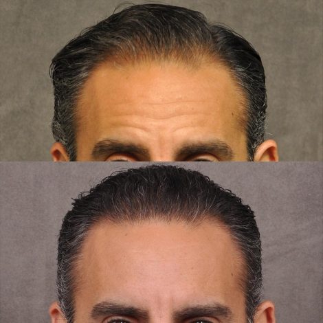 Beverly Hills Center Male Patient Before and After FUE hair transplant and Platelet Rich Plasma