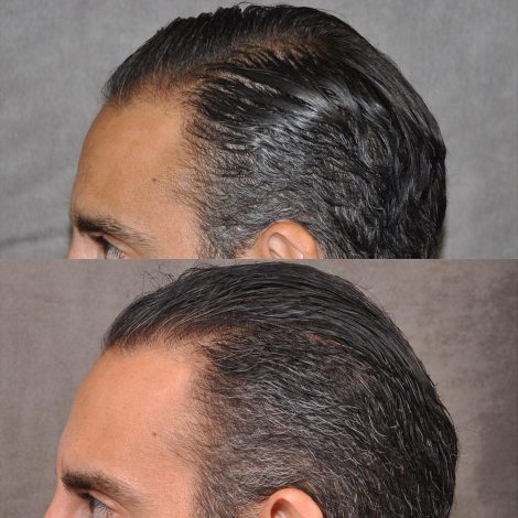 Beverly Hills Center Male Patient Before and After FUE hair transplant and Platelet Rich Plasma