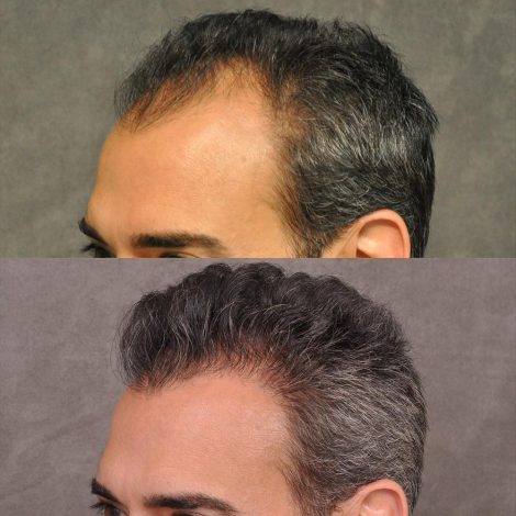 Beverly Hills Center Male Patient Before and After FUE hair transplant