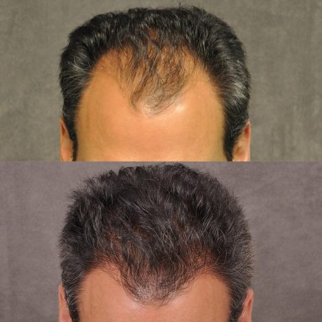 Beverly Hills Center Male Patient Before and After FUE hair transplant
