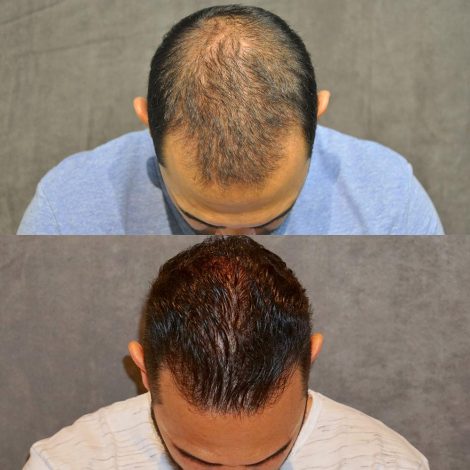 Beverly Hills Center Male Patient Before and After FUE hair transplant and Platelet Rich Plasma