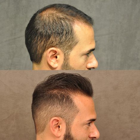Beverly Hills Center Male Patient Before and After FUE hair transplant and Platelet Rich Plasma