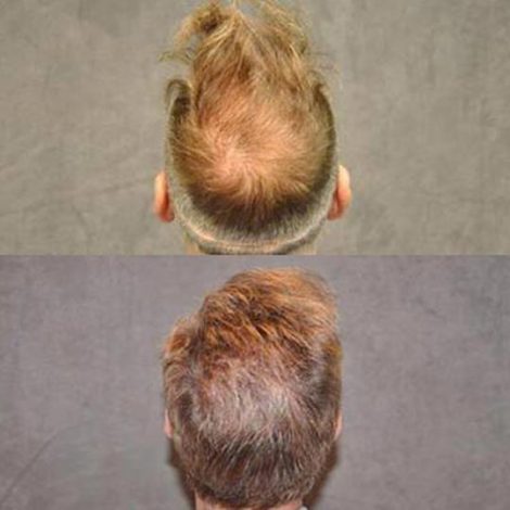 Beverly Hills Center Male Patient Before and After FUE hair transplant and Platelet Rich Plasma