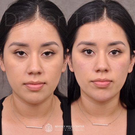 Fillers - Tear trough, chin and cheek.