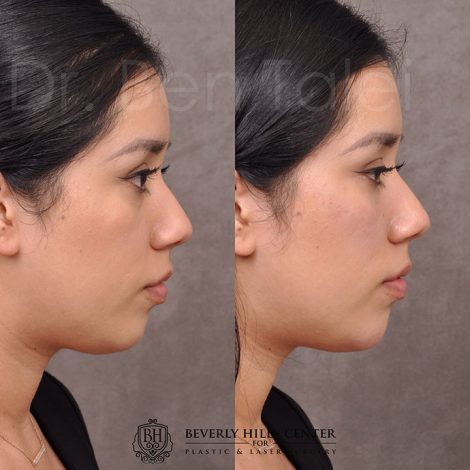 Fillers - Tear trough, chin and cheek.