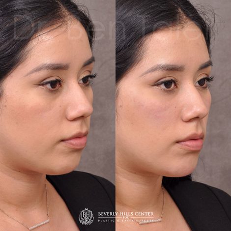 Fillers - Tear trough, chin and cheek.