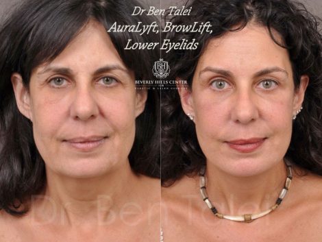 AuraLyft, BrowLift, Lower Eyelids (2 months post) - Front