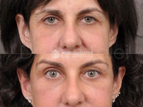 AuraLyft, BrowLift, Lower Eyelids (2 months post) - Front