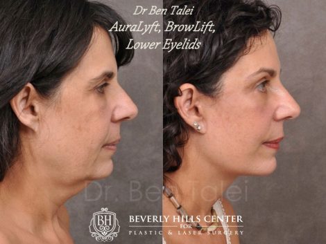 AuraLyft, BrowLift, Lower Eyelids (2 months post) - Right Side
