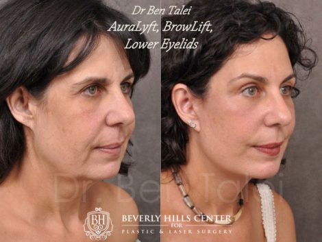 AuraLyft, BrowLift, Lower Eyelids (2 months post) - Right Side