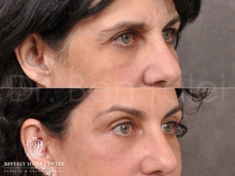 AuraLyft, BrowLift, Lower Eyelids (2 months post) - Right Side