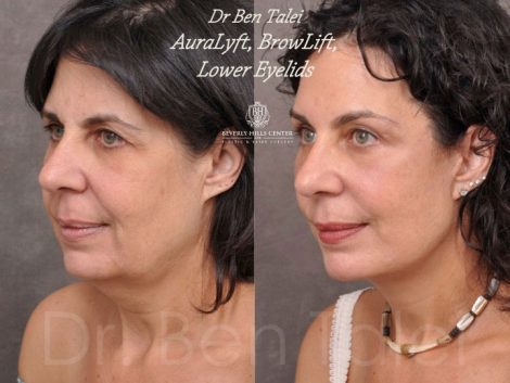 AuraLyft, BrowLift, Lower Eyelids (2 months post) - Left Side