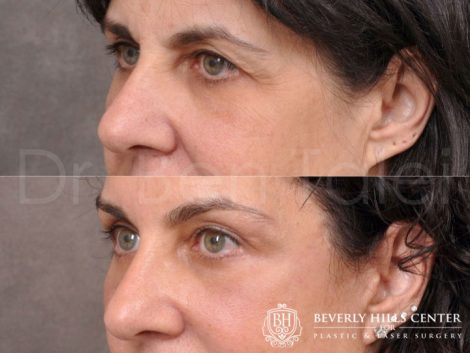 AuraLyft, BrowLift, Lower Eyelids (2 months post) - Left Side