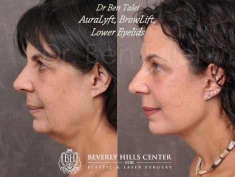 AuraLyft, BrowLift, Lower Eyelids (2 months post) - Left Side