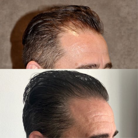 Beverly Hills Center Male Patient Before and After FUE hair transplant and Platelet Rich Plasma